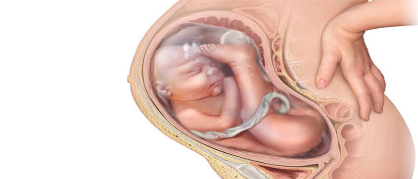 Breech Birth - Complications associated with breech births