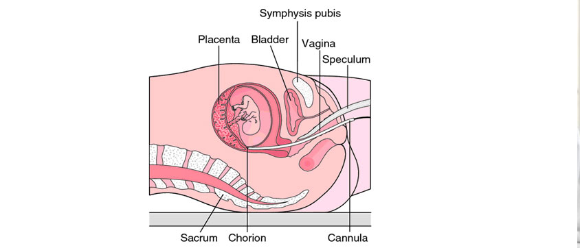 Chorionic Villi Sampling (CVS)