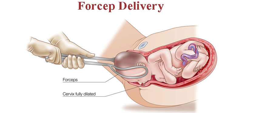 Forcep Delivery