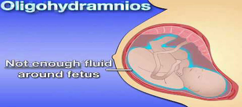 Oligohydramnios