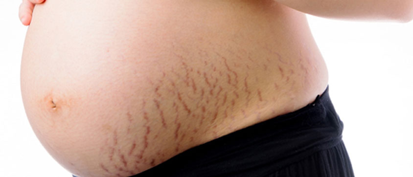 Stretch Marks, Rash and Itchiness