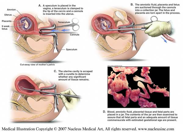 Abortions