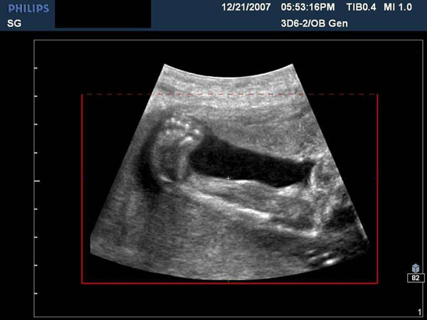 Detecting Abnormalities: Amniocentesis