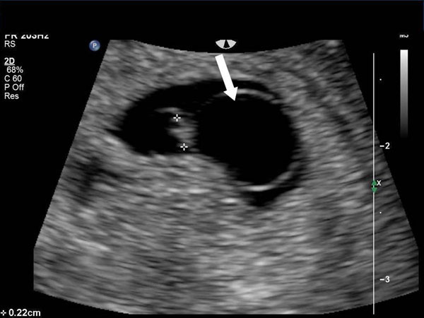 Detecting Abnormalities: Sonography (ultrasound)