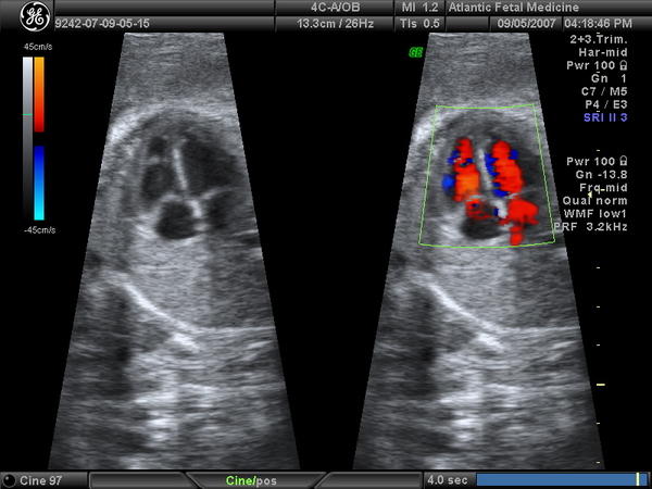 Candidates for High Risk Pregnancy