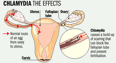 Chlamydia