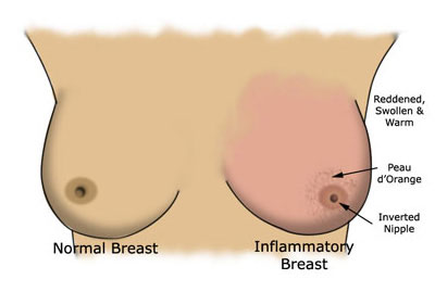 What is Breast Cancer