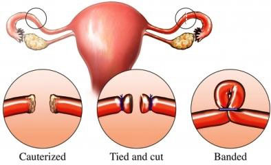 Sterilization