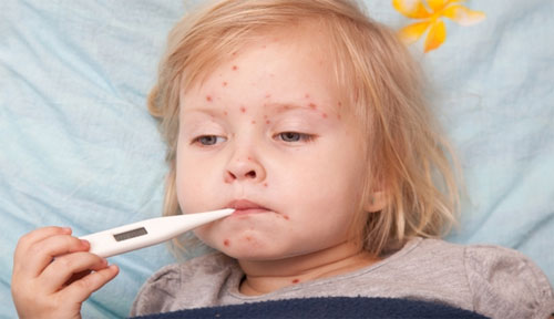 Chicken Pox (Varicella) vaccine