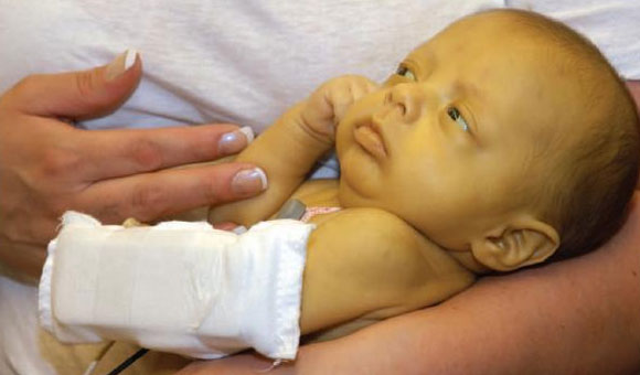 Jaundice in Newborn Babies