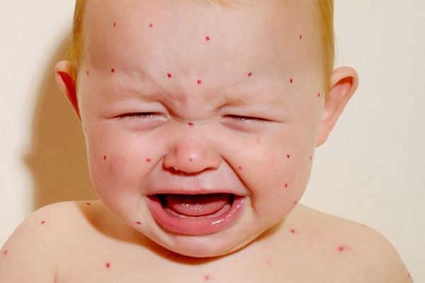 Measles