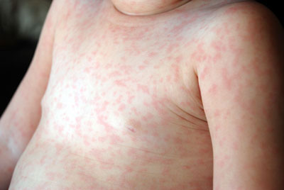 Roseola infantum