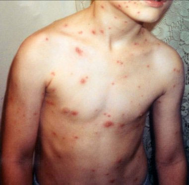 Chicken Pox (Varicella)