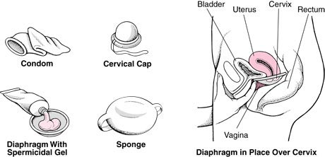 Spermicides - Female Contraceptive Aid