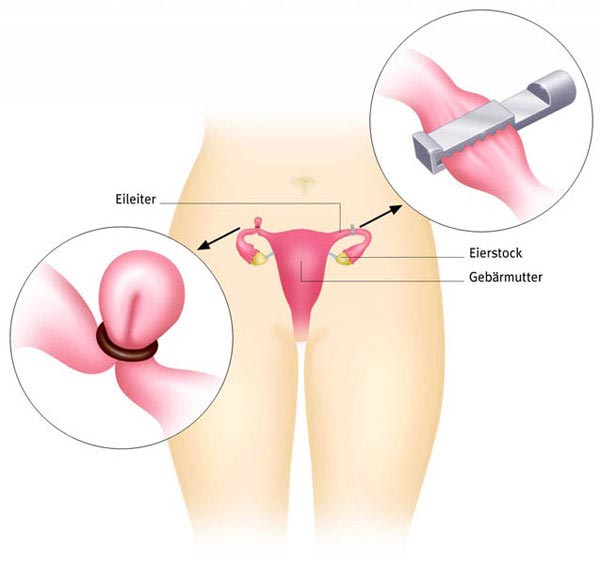 Sterilisation - Permanent Female Contraception