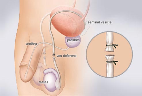 Vasectomy - Permanent Male Contraception