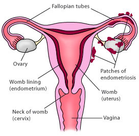 Endometriosis