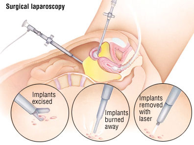 Surgical Treatment of Endometriosis