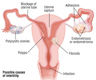 Signs of Infertility in Women