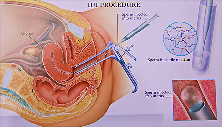 The Basics of IUI Procedure