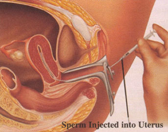 Therapeutic Insemination by Donor (TID)