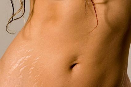 How to Prevent Stretch Marks
