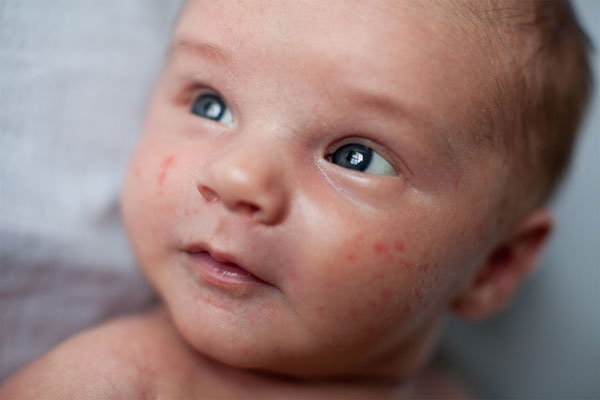 Acne In Babies
