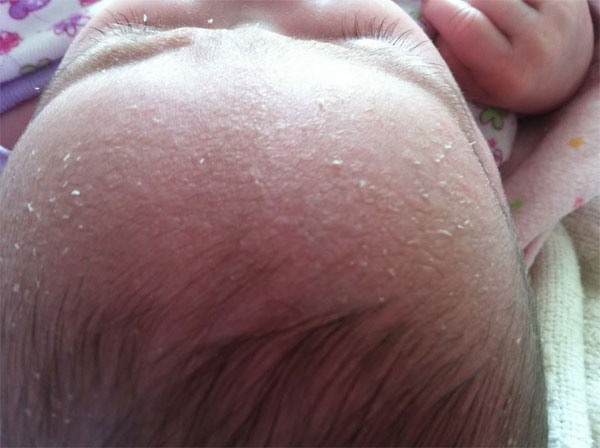 Understanding Cradle Cap