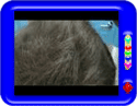 Hair transplant for baldness- Results before and after