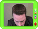 Hair Transplant