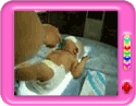 Treatment for Jaundice in Newborns