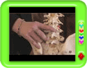 What are Epidurals?