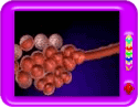 What is bronchitis?