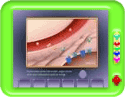 What is Type 2 Diabetes