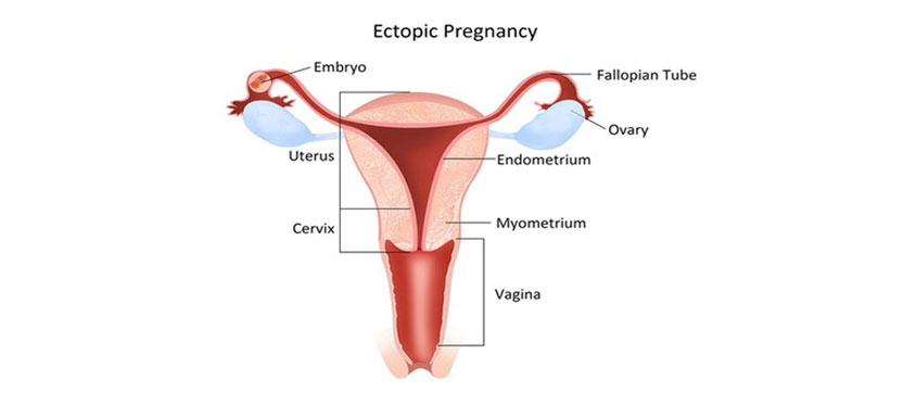 Ectopic Pregnancy