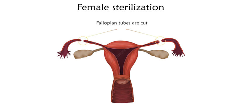 Female Sterilization