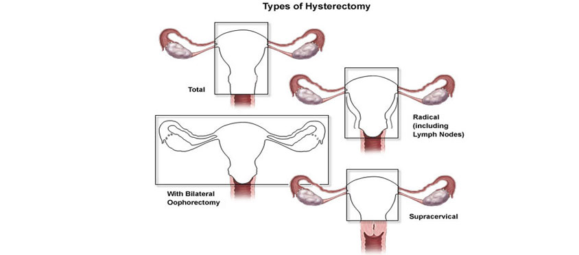 Hysterectomy - Indepth