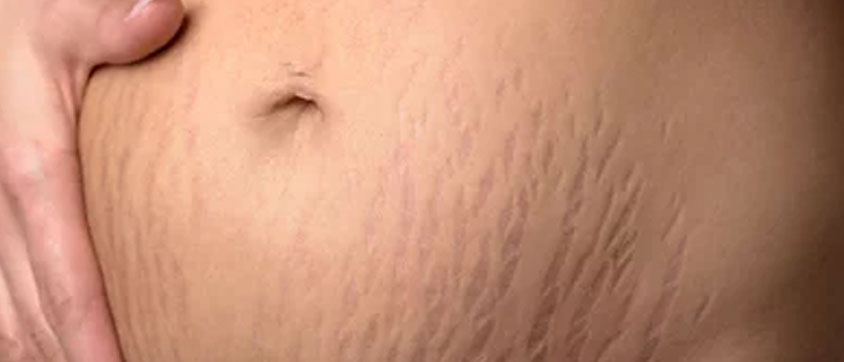 Stretch Marks, Rash and Itchiness