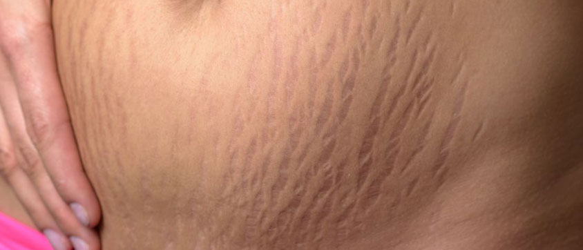 How to Prevent Stretch Marks
