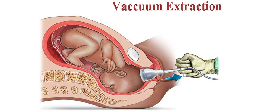 Что находится внутри вакуума Vaccuum Extraction