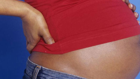 haemorrhoids during pregnancy