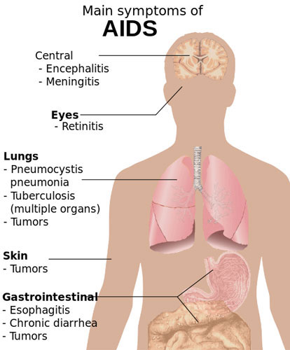 How and why exactly do AIDS patients die?