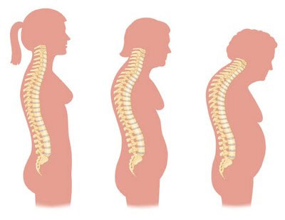 Osteoporosis and its Symptoms