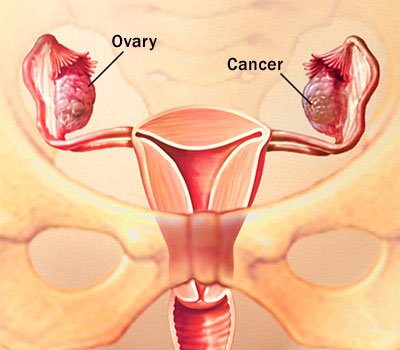 What is Ovarian Cancer