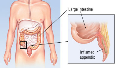 Dealing with appendicitis (inflamed appendix)
