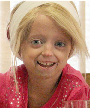 Progeria Disease in Children