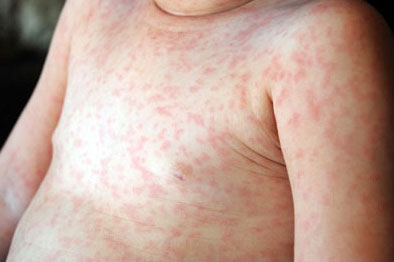 German Measles or Rubella