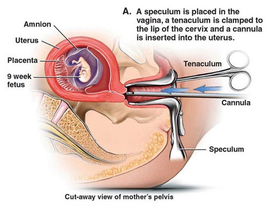 Abortion