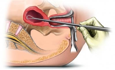 D & C Procedure