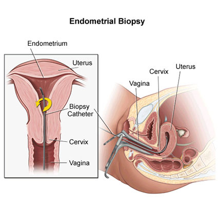 Endometrial Biopsy